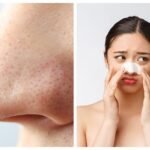 750xauto pori pori jadi bersih ini cara hilangkan komedo di hidung pakai kombinasi baby oil dan 1 jenis minyak 2407045 - Info Malang Raya