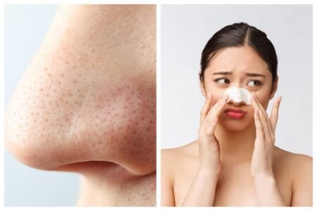 750xauto pori pori jadi bersih ini cara hilangkan komedo di hidung pakai kombinasi baby oil dan 1 jenis minyak 2407045 - Info Malang Raya