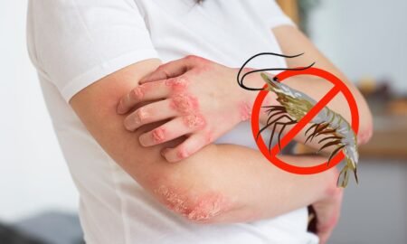 Cara Mengatasi Alergi Udang - Info Malang Raya