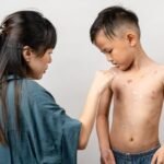 Cara mengatasi alergi bentol bentol pada anak - Info Malang Raya
