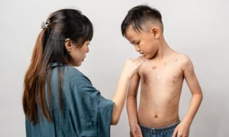 Cara mengatasi alergi bentol bentol pada anak - Info Malang Raya