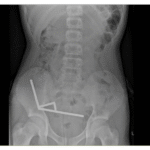 Bahaya! 100 Magnet Ditemukan di Perut Remaja AA1PeN3c - Info Malang Raya