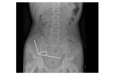 Bahaya! 100 Magnet Ditemukan di Perut Remaja AA1PeN3c - Info Malang Raya