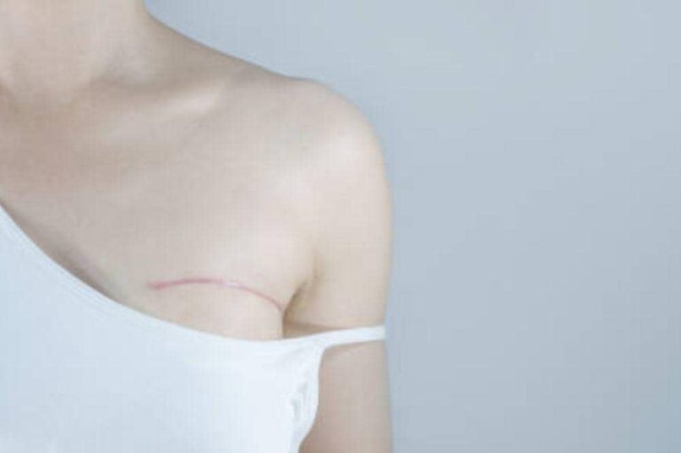 Kanker Payudara Stadium 4: Gejala dan Pengobatan