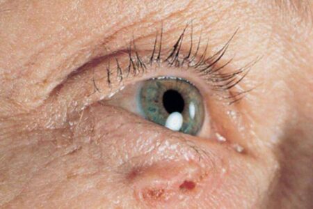 6 tanda kanker kulit, jangan abaikan perubahan ini