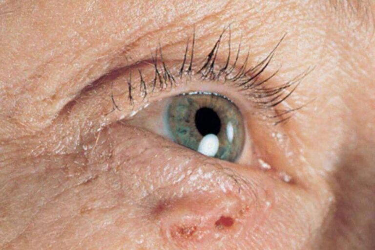 6 tanda kanker kulit, jangan abaikan perubahan ini