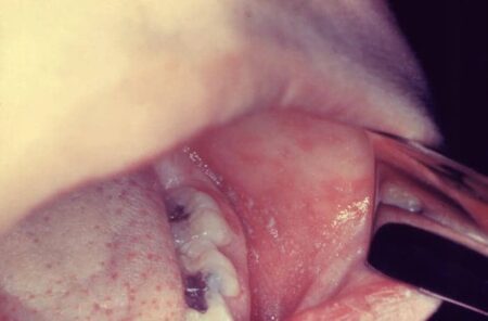 Garis waktu gejala campak harian