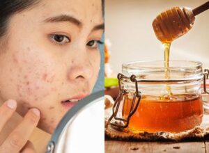 Cara Menghilangkan Bopeng Jerawat dengan Madu